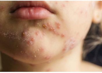 Qızılca epidemiyası ABŞ-ın 12 ştatına yayılıb