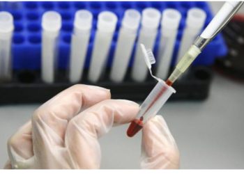 HİV-in müalicəsində tarixi addım: Virus hüceyrə daxilində görünməyə başladı