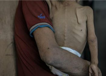 Qəzzada aclığın fəsadlari: İsrailin siyasəti aclığı necə dərinləşdirdi